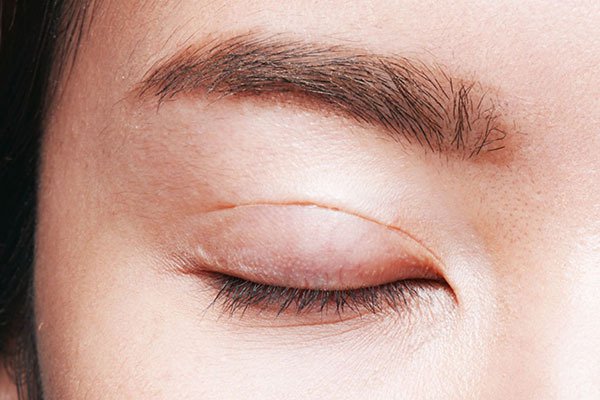 Quy trình nhấn mí mắt không quá phức tạp nên ít xảy ra biến chứng