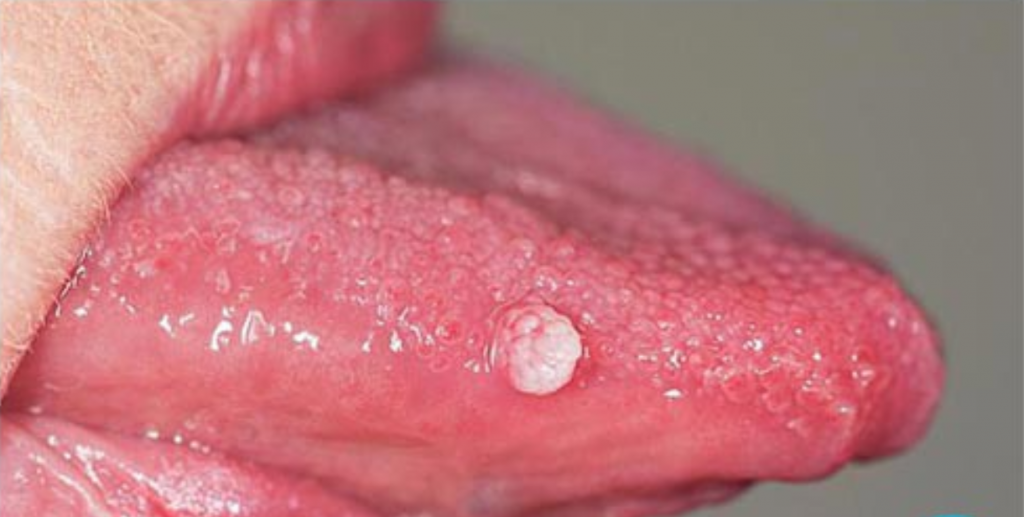 Ngoài cơ quan sinh dục, lưỡi là bộ phận yêu thích của virus sùi mào gà